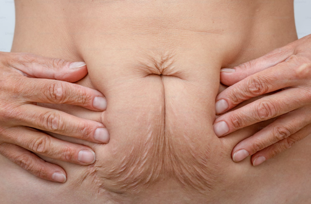 fake-flacidez-corporal flacidez-corporal